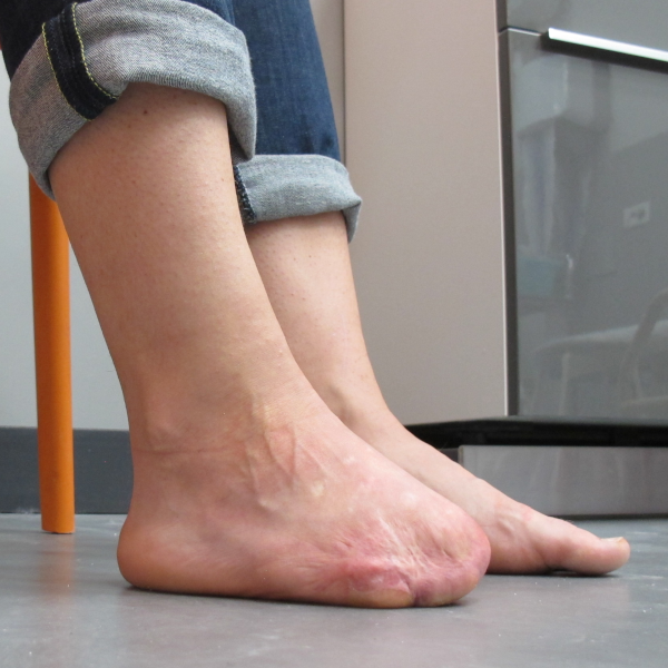 prothèse esthétique personnalisée "design" en silicone pour amputation partielle de pied